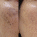 7.0 melasma treatment before after