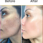 before after face prp 1